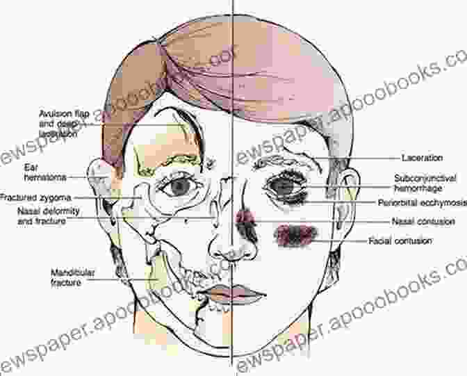 Anatomy Of Facial Trauma Essentials Of Craniomaxillofacial Trauma Graham Dale