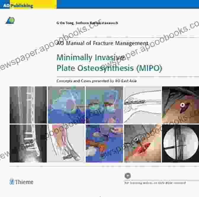 Cover Of The Book 'Minimally Invasive Plate Osteosynthesis' By Mipo Ao Publishing Minimally Invasive Plate Osteosynthesis (MIPO) (AO Publishing)