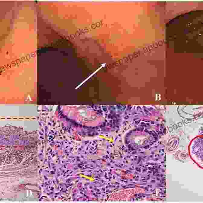 Endoscopic Image Of A Gastric Ulcer Clinical Challenges Images In Gastroenterology: A Diagnostic Guide