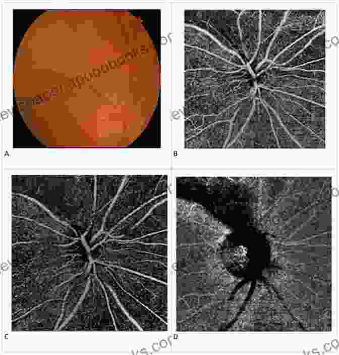 OCT Angiography Image Of The Retinal Vasculature, Revealing Intricate Patterns Of Blood Flow Optical Coherence Tomography Of Ocular Diseases: Third Edition