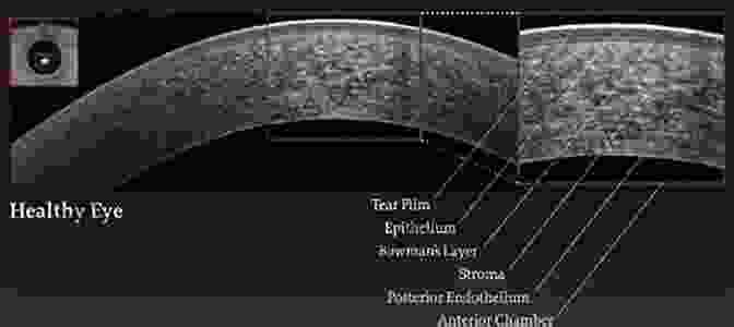 OCT Image Of The Cornea, Displaying Its Layered Structure And Thickness Measurements Optical Coherence Tomography Of Ocular Diseases: Third Edition