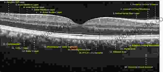 OCT Image Of The Human Retina, Revealing The Intricate Layering And Structures Optical Coherence Tomography Of Ocular Diseases: Third Edition