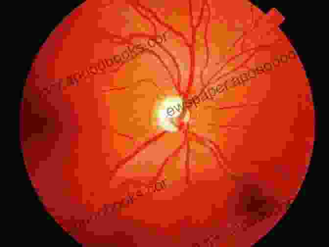 OCT Image Of The Optic Nerve Head In A Patient With Glaucoma, Demonstrating Characteristic Cupping And Loss Of Nerve Fiber Layer Optical Coherence Tomography Of Ocular Diseases: Third Edition