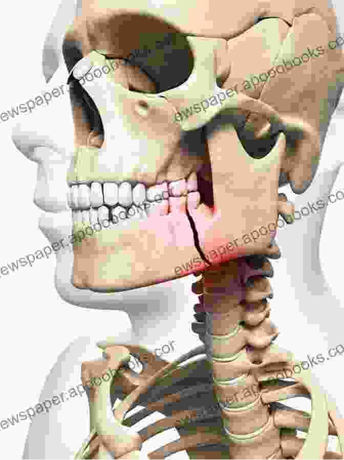 Treatment For Facial Trauma Essentials Of Craniomaxillofacial Trauma Graham Dale