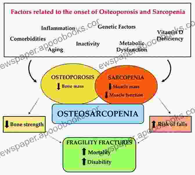 Unlock The Secrets Of Osteosarcopenia: A Comprehensive Guide By Gustavo Duque, A Leading Expert In Bone And Muscle Health Osteosarcopenia Gustavo Duque